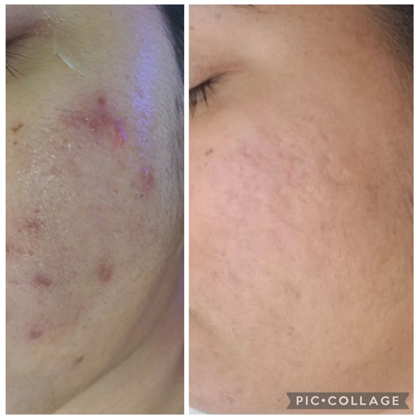 Cheek before and after treatment for inflammatory acne.