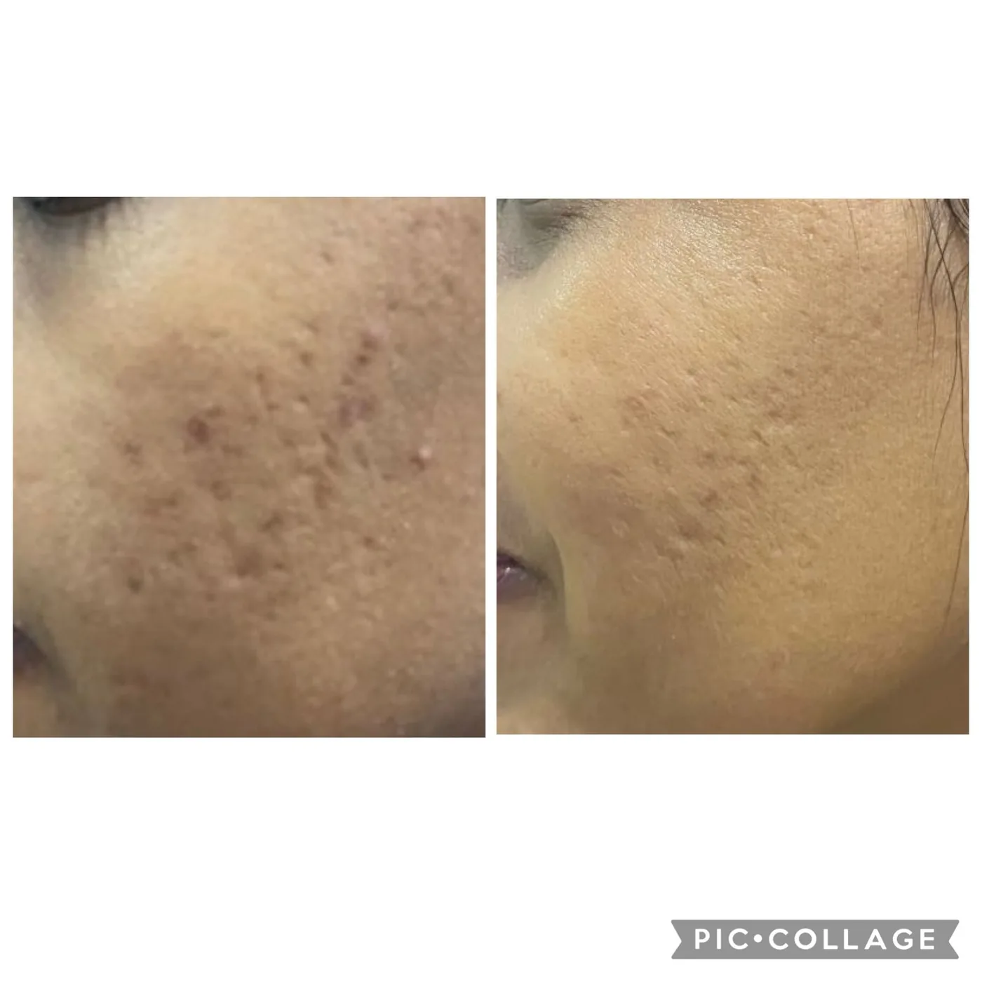 Cheek before and after treatment for acne scarring.