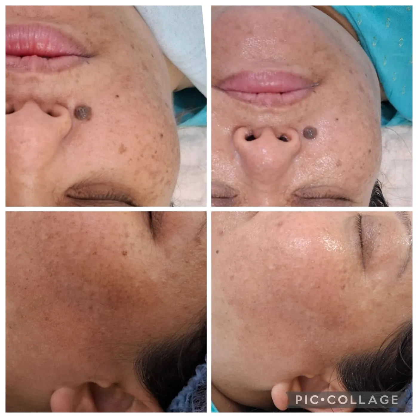 Face before and after treatment for pigmentation, shown from two angles.