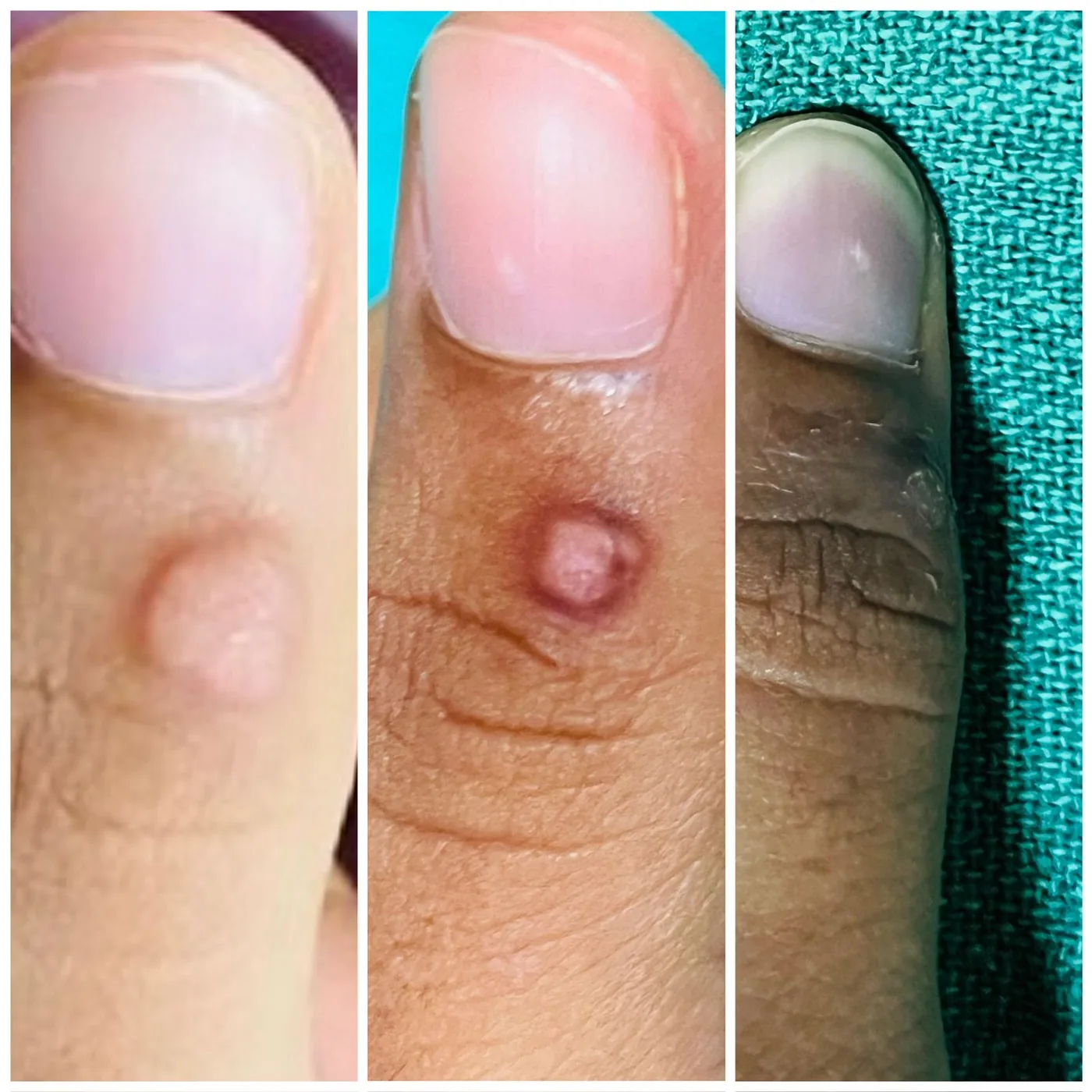 A lesion on the finger photographed at three stages of treatment.