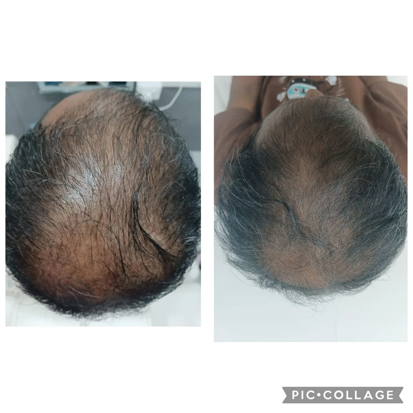 Crown of the scalp before and after treatment for hair loss.