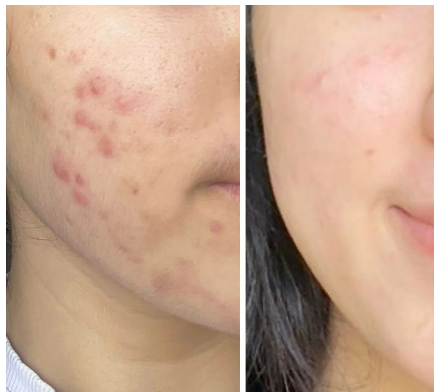Jawline before and after treatment for inflammatory acne.