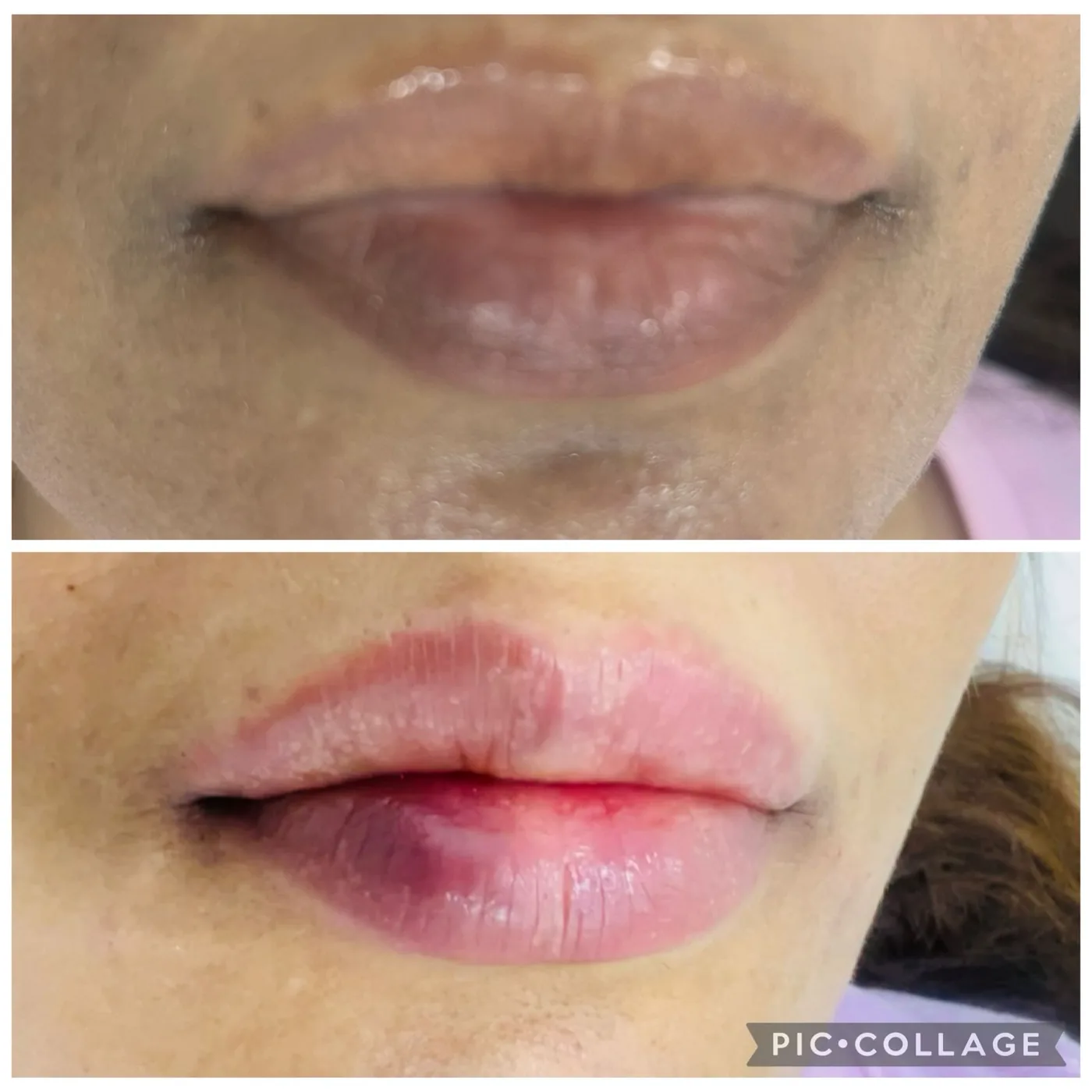 Lips before and after dermal filler.