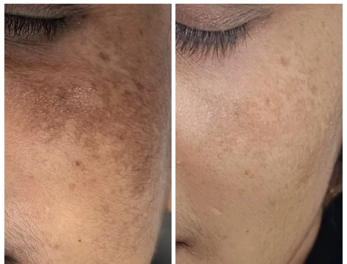 Cheek before and after treatment for melasma.