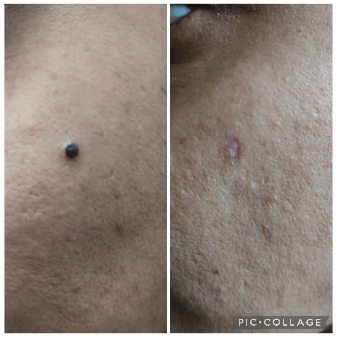 Raised mole before removal and the healing skin afterwards.