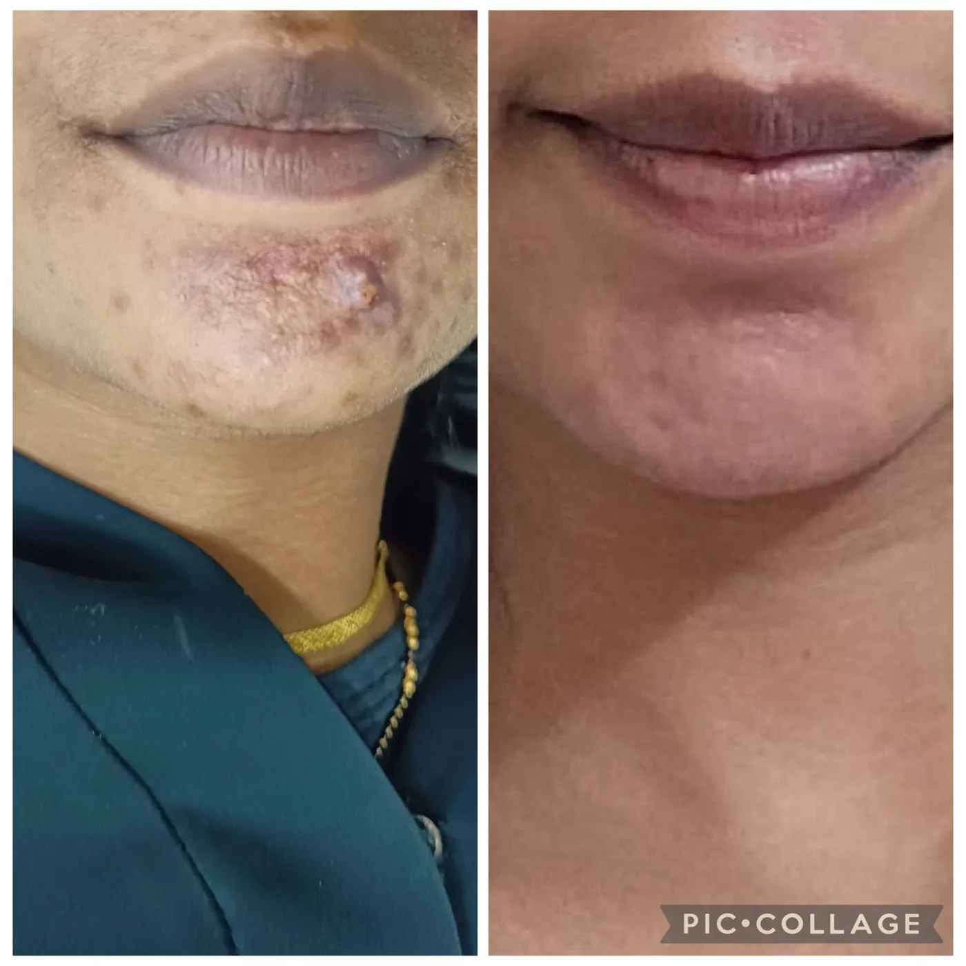 Chin and perioral area before and after treatment for acne with pigmentation.