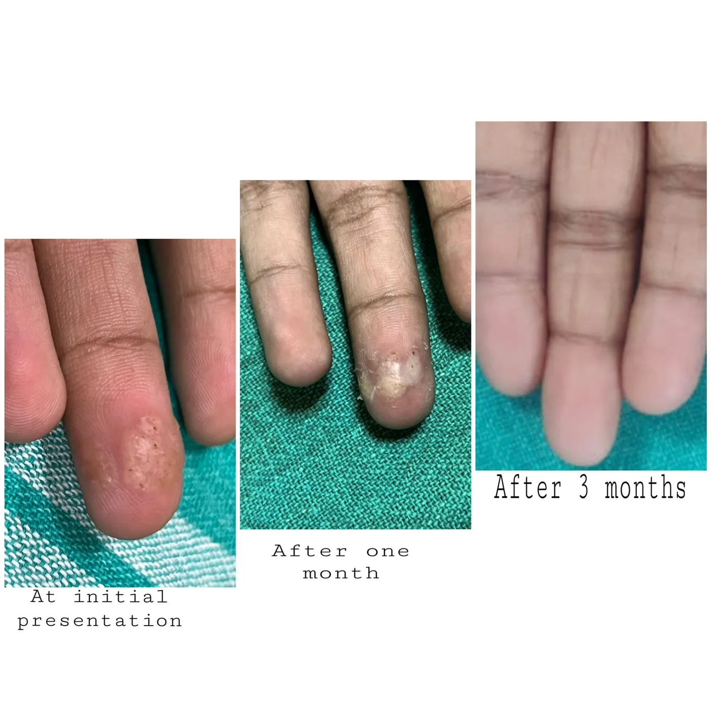 A wart beside the fingernail at first visit, after one month, and after three months.