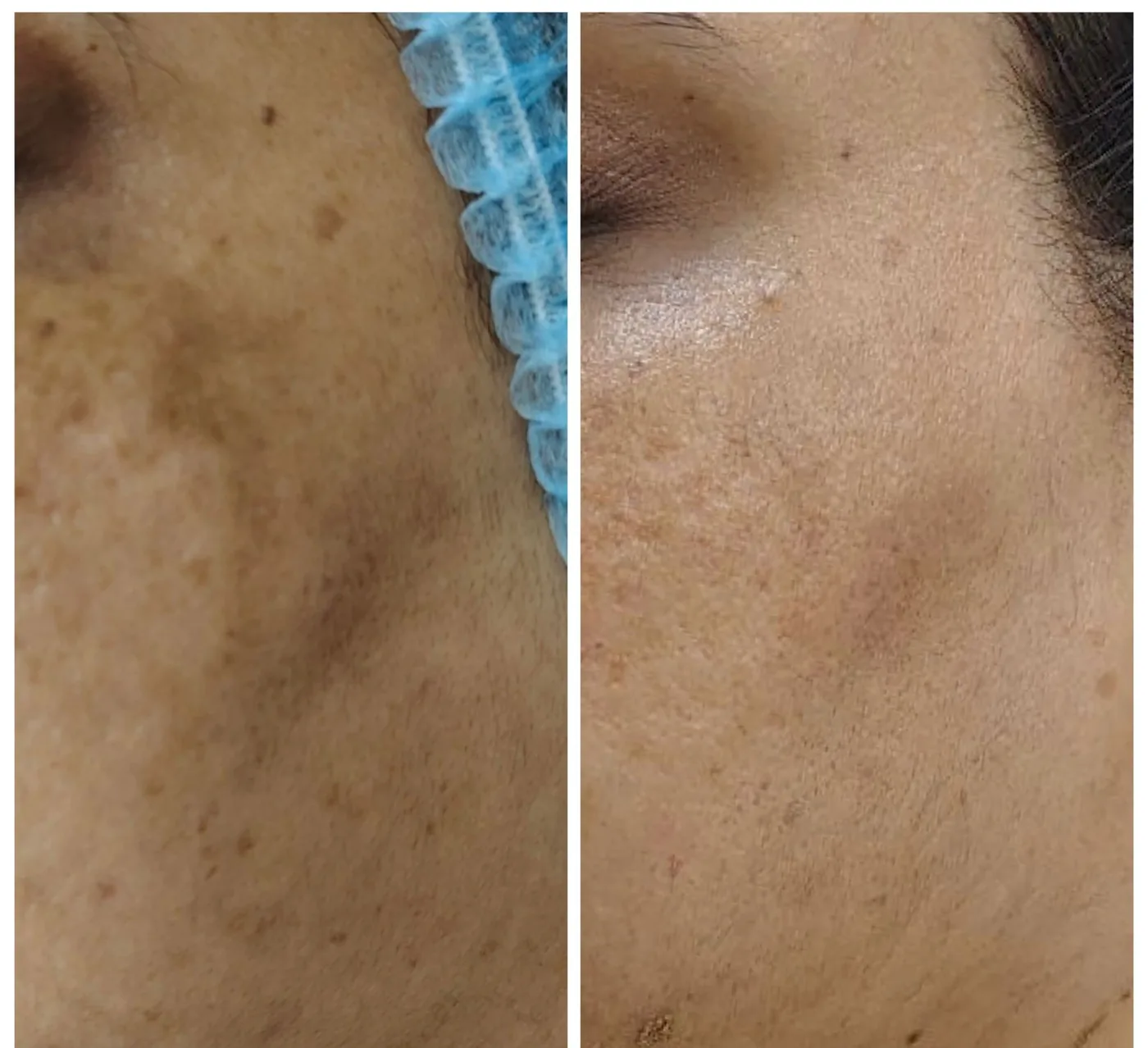 Cheek before and after treatment for facial pigmentation.