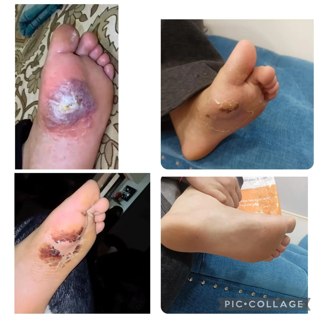 A wart on the sole of the foot photographed across four stages of treatment.