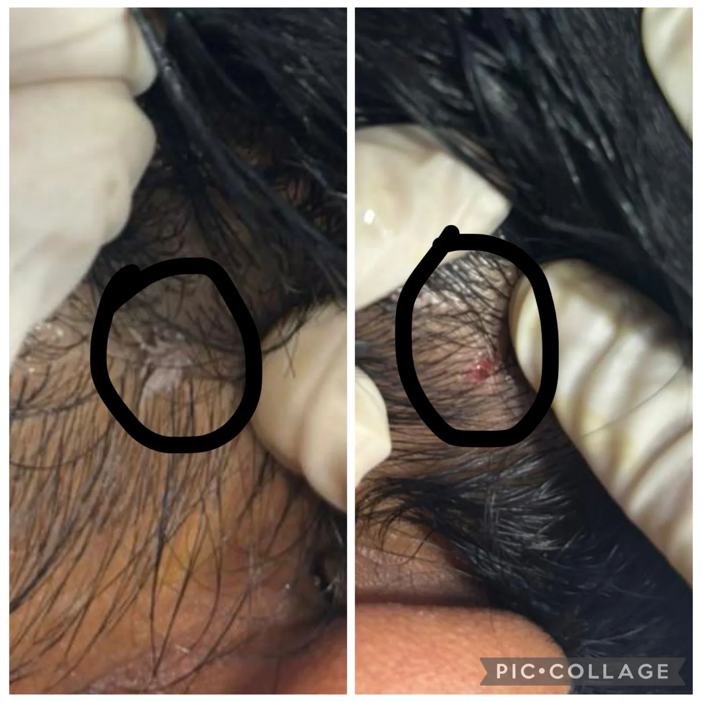 Scalp lesion before and after treatment, circled in both frames.