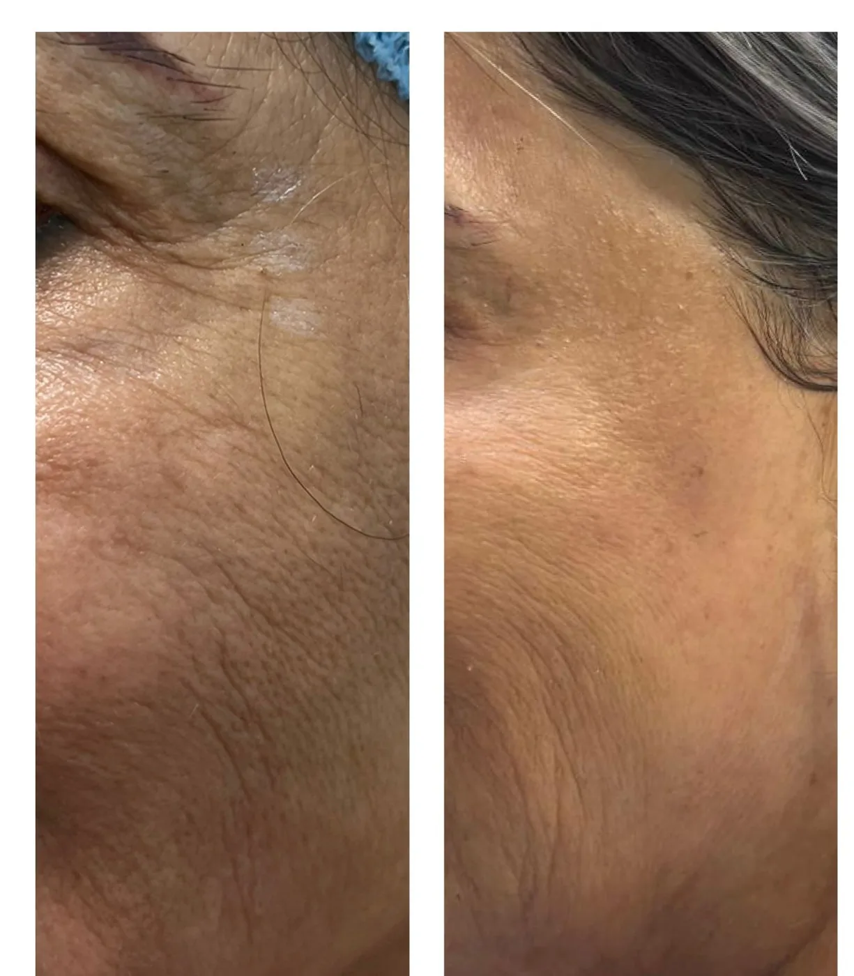 Jawline and neck before and after treatment for skin texture.