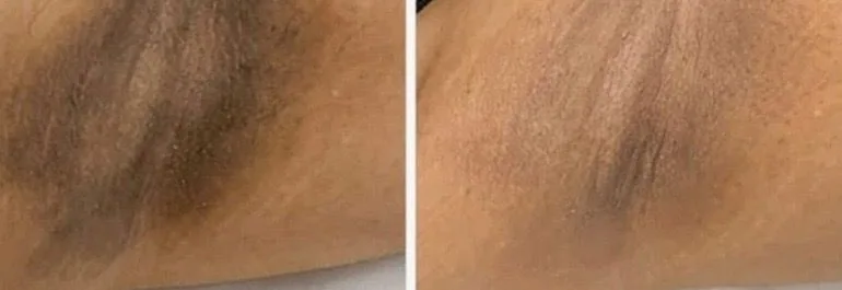 Underarm before and after treatment for pigmentation.